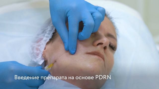 Векторный лифтинг PDRN