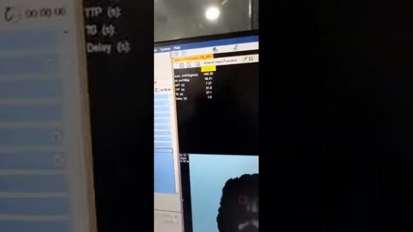 MRI PERFUSION POST PROCESSING