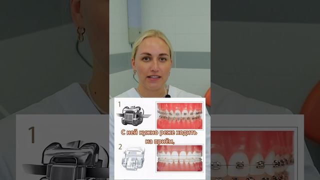 Какие бывают брекеты