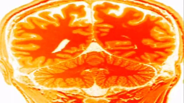 MRI Brain смотреть онлайн