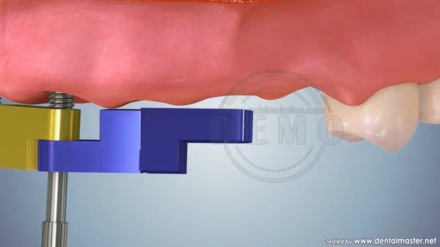 Хирургический инструмент Параллель гайд 2 смотреть онлайн