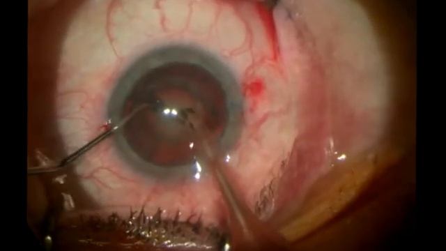 Хирургия катаракты ФЭМ+ИОЛ