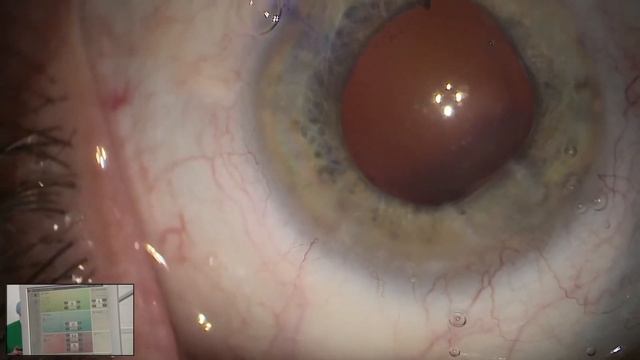 Факоэмульсификация катаракты на системе EVA с имплантацией линзы AquaFree Natural Toric Preloaded