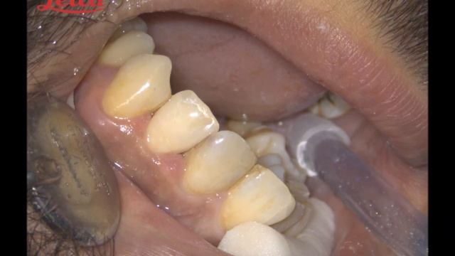 LEİCA M320 Composite Resin Restoration