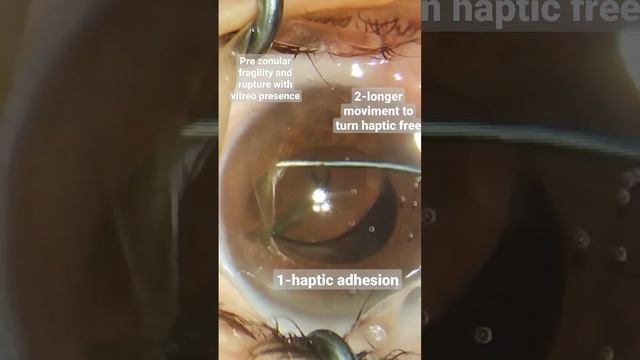 Zonular Fragility In Phacoemulsification Cataract Surgery