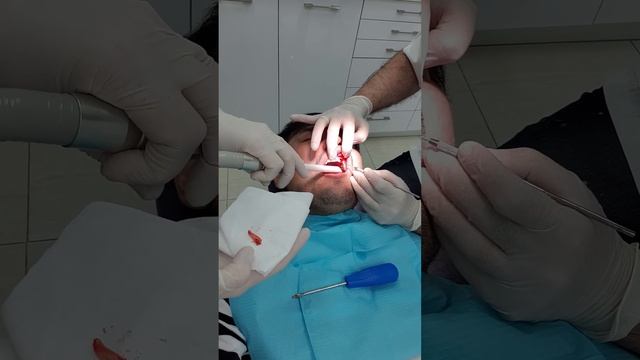удаление зуба смотреть онлайн