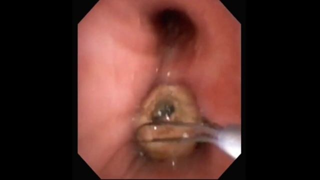 Plum Seed Removal Ll Lung Foreign Body Removal At SQUARE HOSPITAL LTD Dhaka Bangladesh #BD_ENDOSCOP