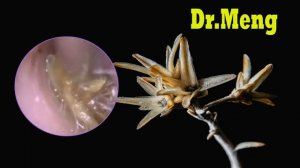 Ear Wax Removal Endoscopic |Удаление ушной серы с помощью эндоскопического микроскопа