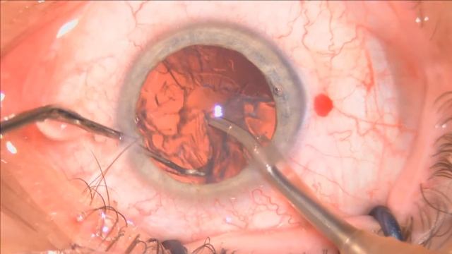 Oculentis Mplus LS313MF20  1.8MICS Lukan Mishev Live Stream