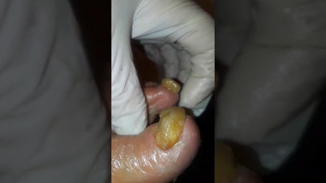 My Skin Journey, 2019 to 2020: Toe Nail falling off. смотреть онлайн