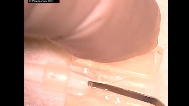 ФАКО с имплантацией ИОЛ Optovet AnIOL 40D-5510 / PHACO With Implantation IOL Optovet AnIOL 40D-5510