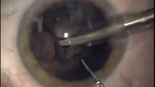 Факоэмульсификация случай 18