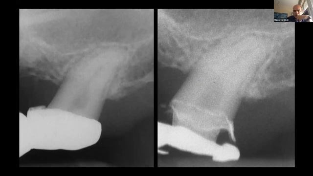 Isolation of cases in endodontics(How? When? Why?)_Invited speaker: Dr. Filippo Cardinali смотреть онлайн