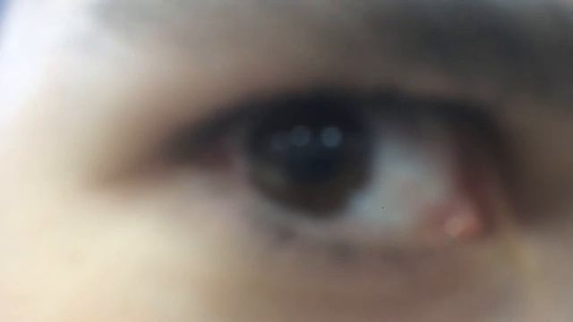 КРОВАВЫЙ глаз!!!