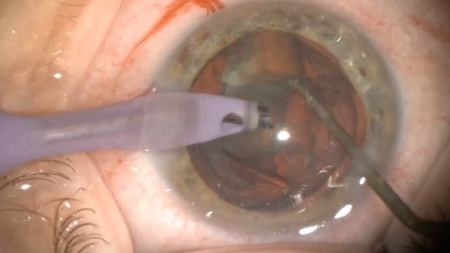 Операция на переднем отрезке смотреть онлайн