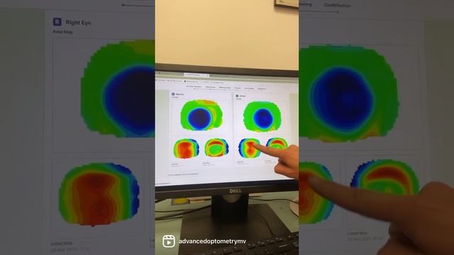 How Ortko-K (CRT) Myopia Management Works