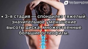 Поясничный спондилез: причины, симптомы и лечение