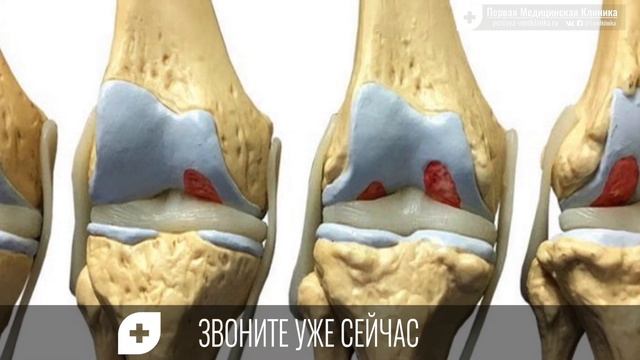 Лекарства от артрита