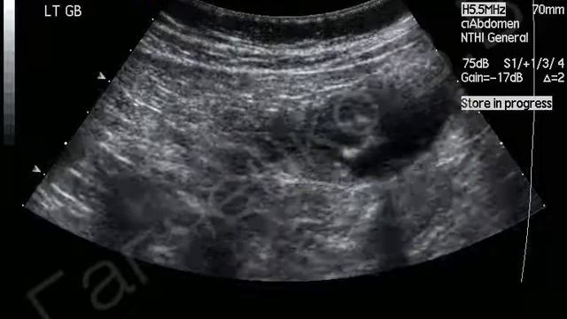 УЗИ толстого кишечника с контрастированием, РАК смотреть онлайн