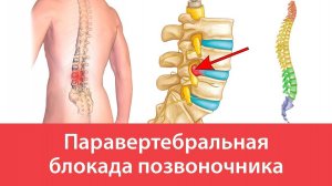 Паравертебральная блокада позвоночника