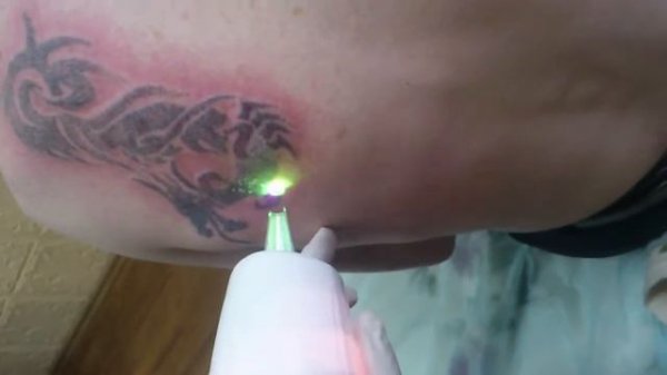 Удаление тату лазером