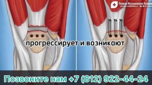 Последствия разрыва связок коленного сустава: осложнения болезни