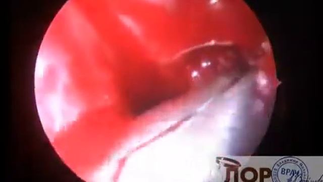 Эндоскопическая шейверная микрогайморотомия..mp4 смотреть онлайн