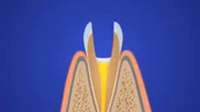 Пульпит - частое явление