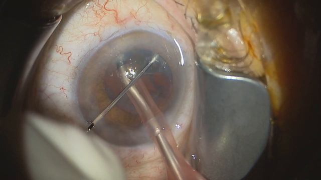 06 Phaco 20230201 164132 Clareon Alcon