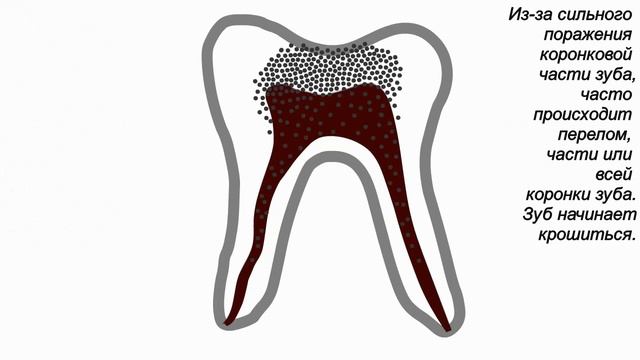 Кариес. Поражение зуба кариесом. Лечение кариеса.