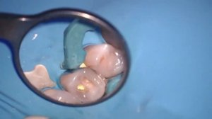 Лечение пульпита (удаление нерва)