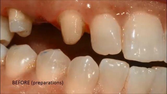 From PFM to Zirconia Bridge смотреть онлайн