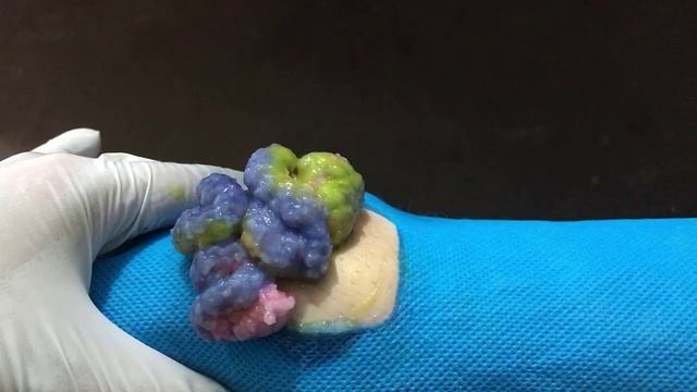 Best Pimple Popping    Cysts Removal    Blackhead Removal    Super Cysts    Oddly Satisfy    VD#083