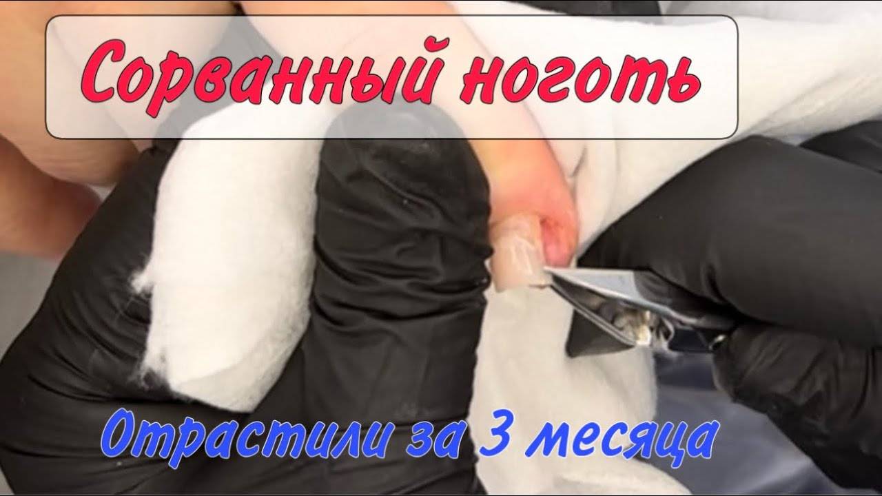 Сорванный ноготь_ оторвался ноготь_ если оторвался ноготь смотреть онлайн