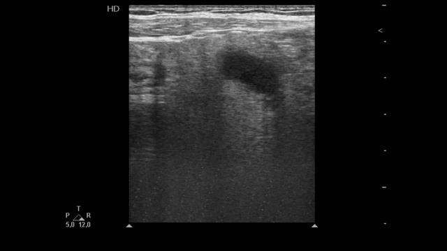 Острый флегмонозный аппендицит. Acute phlegmonous appendicitis смотреть онлайн