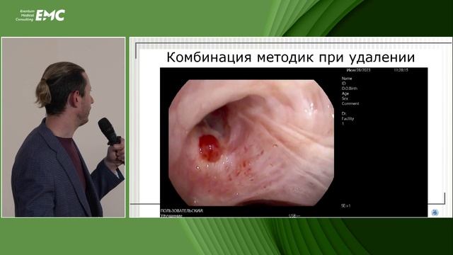 2. Эндоскопические вмешательства при опухолях трахеи и бронхов (опыт клиники). Дробязгин Е.А.