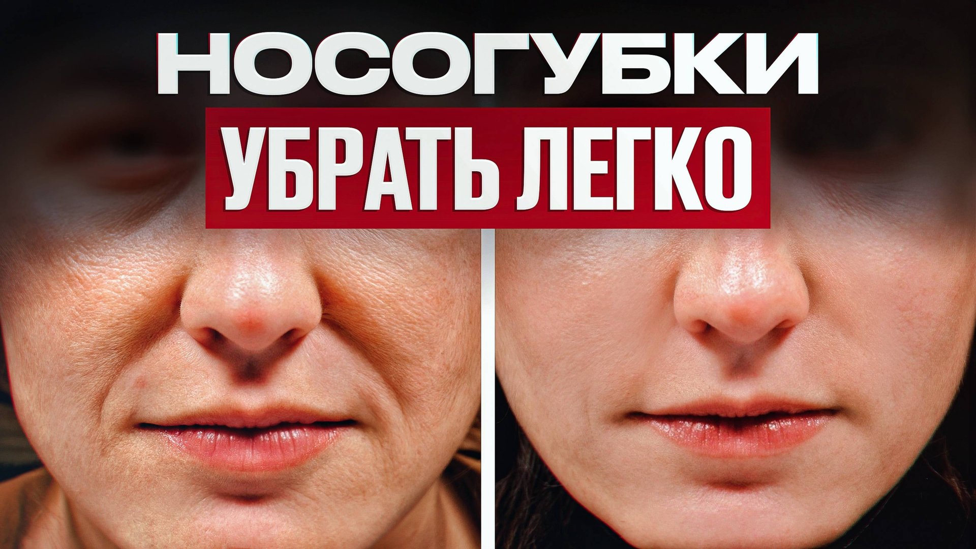3 БЕЗОПАСНЫХ способа убрать носогубку / Как ИЗБАВИТЬСЯ от носогубных складок навсегда? смотреть онлайн
