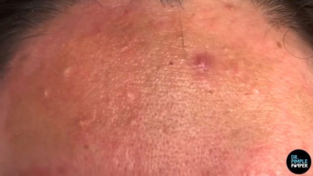 Comedones Galore On Face And Forehead!        Dr Pimple Popper Pops & Removes Comedones