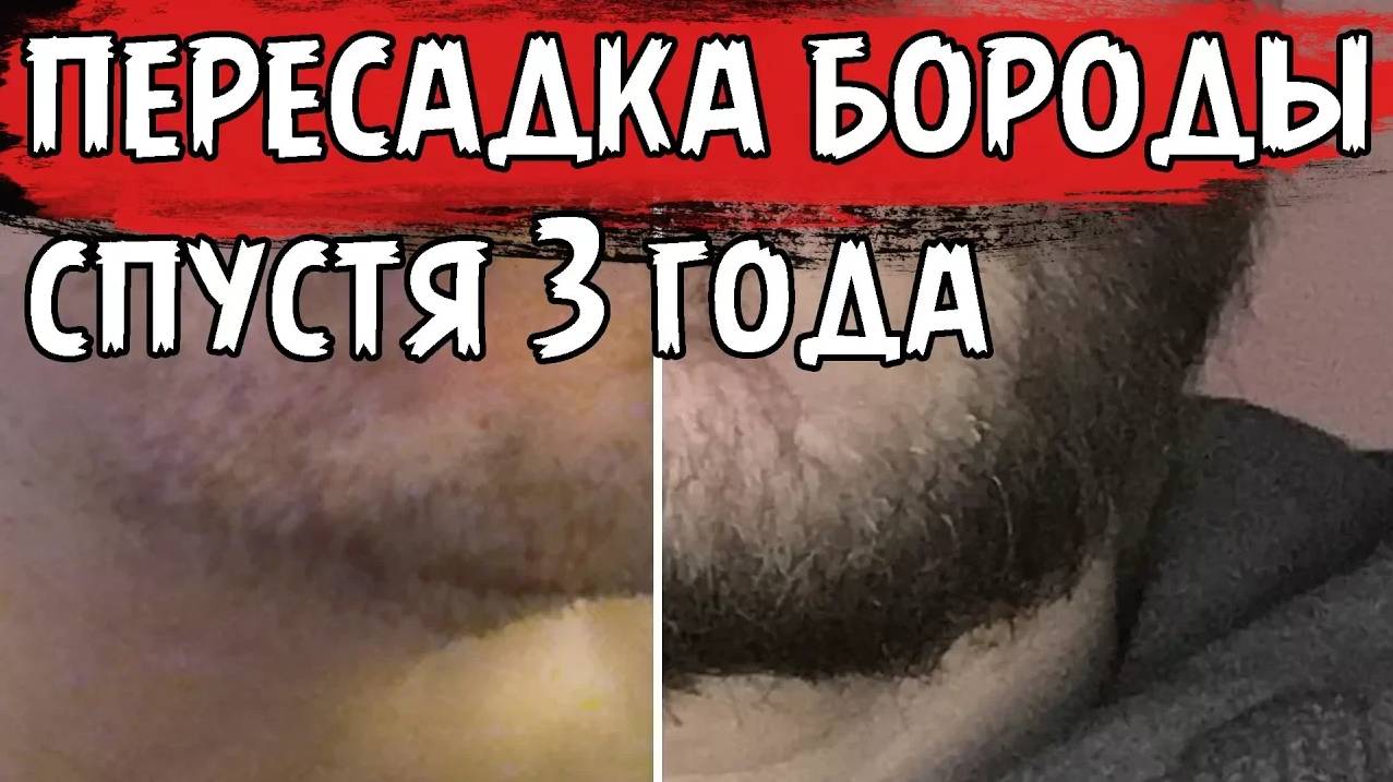 3 ГОДА ПОСЛЕ ПЕРЕСАДКИ БОРОДЫ! смотреть онлайн
