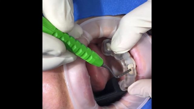 Surgical dental clinical technique video #5: 3D CBCT surgical guide tips - Dr. Lastimado, MAGD смотреть онлайн