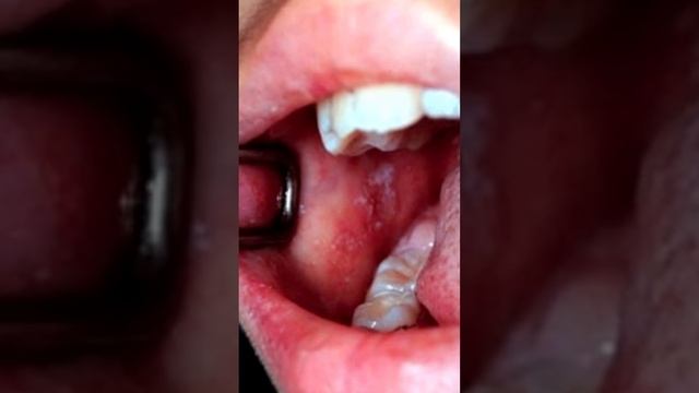 Кизамик #рвота #ангина #вирус #корь #вакцина # смотреть онлайн