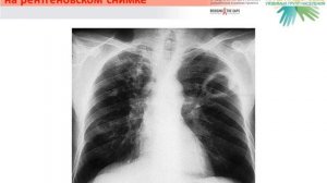 Учебный фильм Клинические проявления туберкулеза