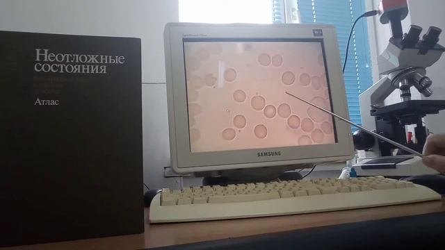 Какие анализы показывают, что кровь "густая". Видео №3. смотреть онлайн