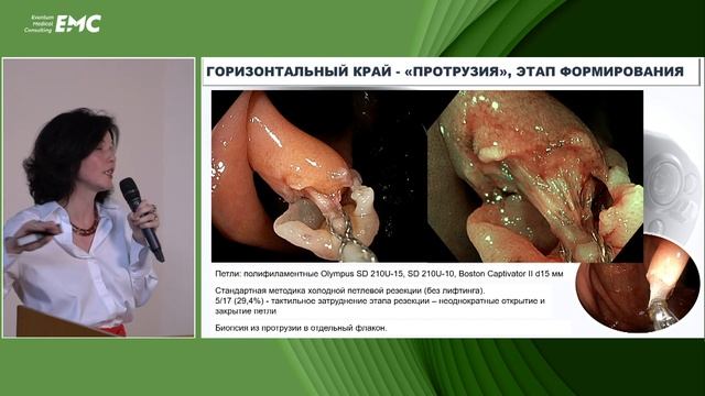 2 Оценка радикальности вмешательства в трехмерном пространстве эндоскопии. Агейкина НВ, Валиулин ИР