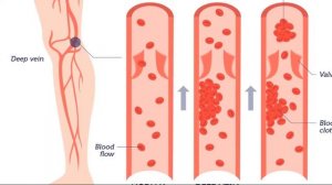 ТРОМБОЗ ВЕН НА НОГАХ | Что такое тромбоз и как его предотвратить