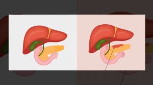 Панкреатит: что это такое и как правильно питаться при данном заболевании?