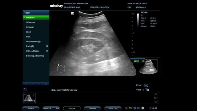 УЗИ ОБП и почек (полное исследование) смотреть онлайн