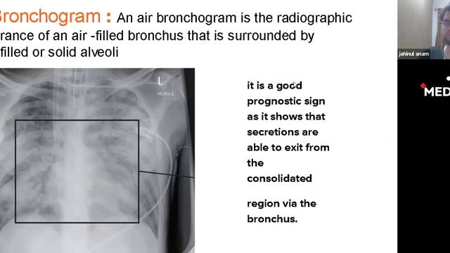 Basic of X-Ray || Discussion on common X-Rays for final Prof( Class -2) смотреть онлайн