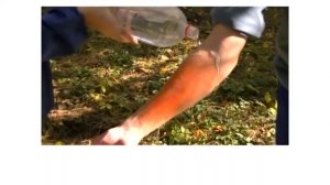 Первая помощь при ожогах