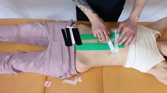 4.1. Диастаз на начальной стадии, тейпирование